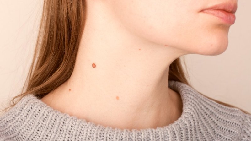 Verrugas en el cuello