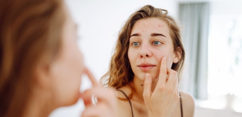 Acn�, �qu� es?