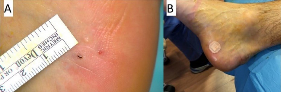 Tratar con cirugia ecoguiada la fascitis plantar en el Hospital Universitario La Zarzuela