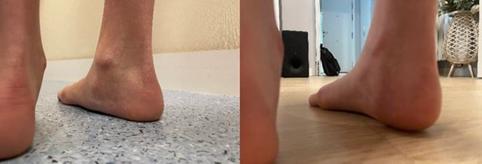 Antes y después de operación pie plano