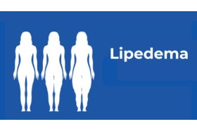 Lipedema_estadios